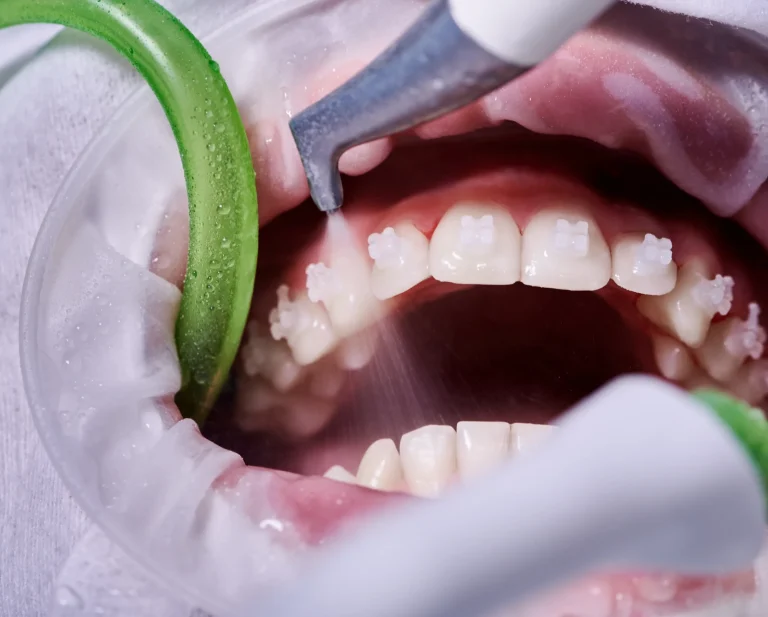 Teeth cleaning suction tool