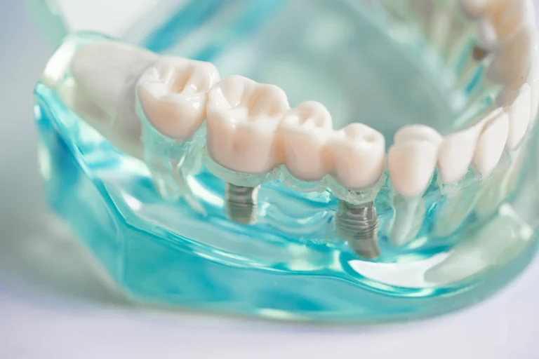 Tooth restoration implant setup