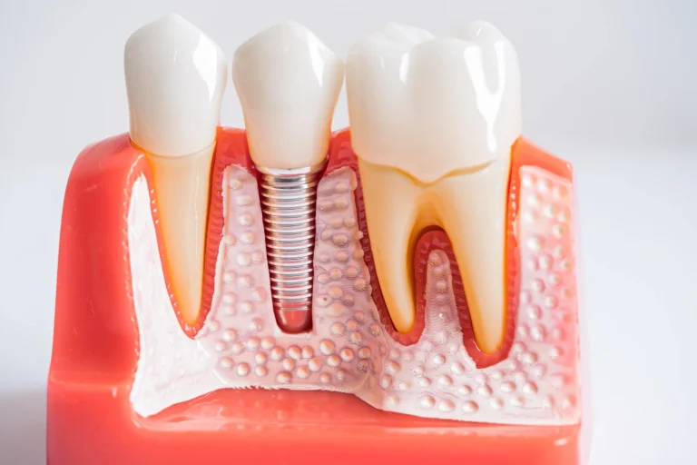 Jawbone dental implant setup