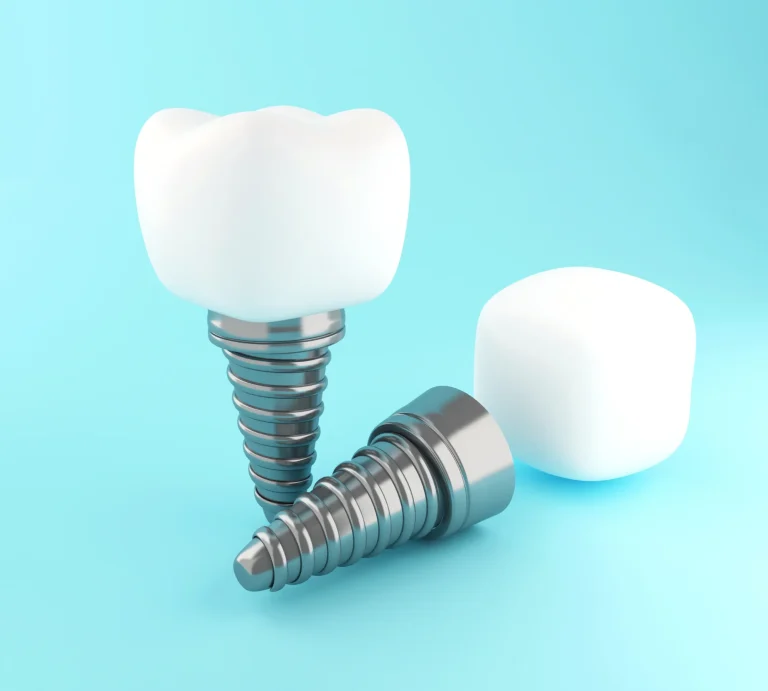 Dental implant restoration