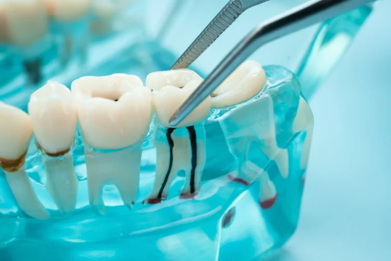 Dental model tooth extraction