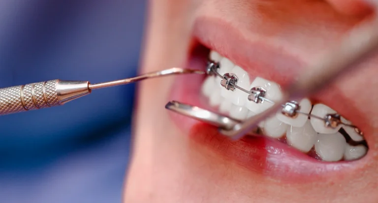 Braces teeth checkup procedure