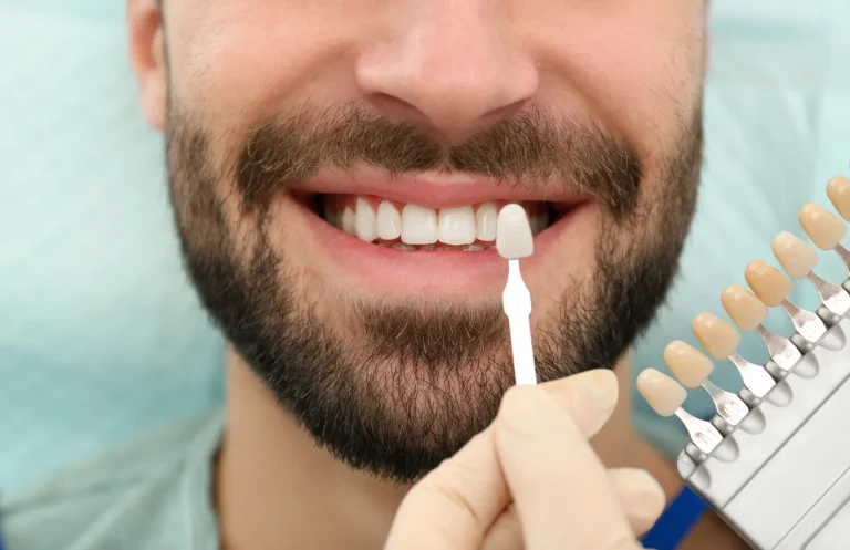 Cosmetic smile color matching
