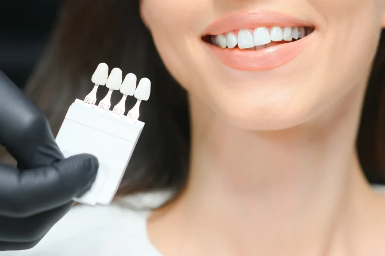Cosmetic dental veneers process